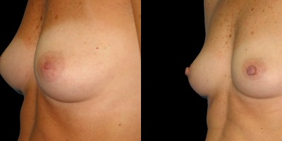 Patient-1-Inverted-Nipples-(2)