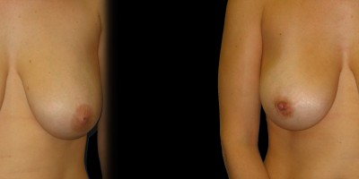 Patient-2-Inverted-Nipples-(2)