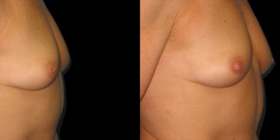 Patient-3-Inverted-Nipple-Repair-(3)